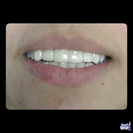 Carillas dentales-PORCELANA