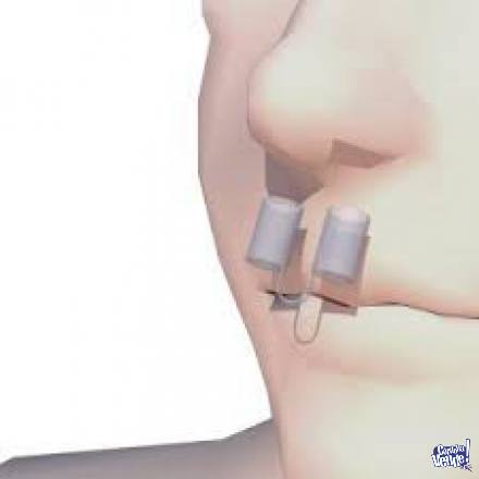 anti ronquido dilatador nasal