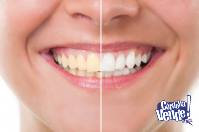 Blanqueamiento Dental + Limpieza Con Ultrasonido - Cordoba